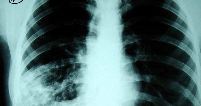 Рентгенографски  изследвания с флуорограф за ранно откриване на туберкулоза сред 