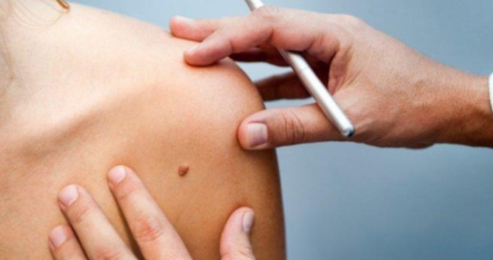 Ракът на кожата се причинява от специални клетки меланоцити