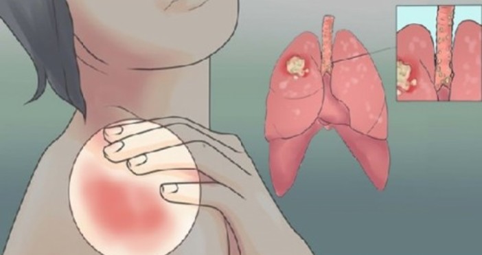 Ракът на белия дроб е вторият най често срещан тип на