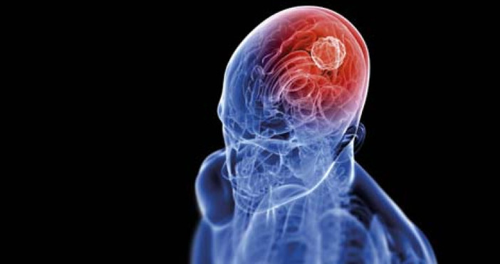Диагнозата тумор на мозъка е плашеща Лечението е дълъг и мъчителен процес За
