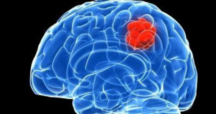 Като правило туморът в мозъка е новообразувание, възникващо вследствие на