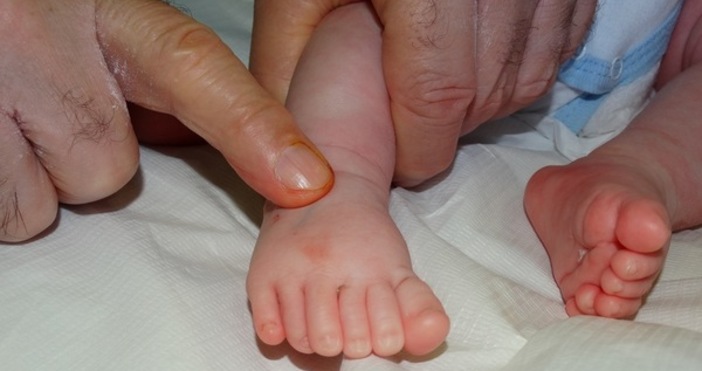 Бебе с шест пръста на всеки крайник бе успешно оперирано