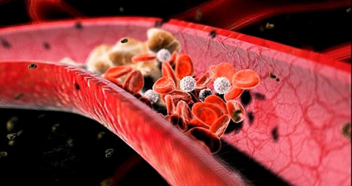 Кръвните съсиреци пречат на свободната циркулация на кръв в тялото.