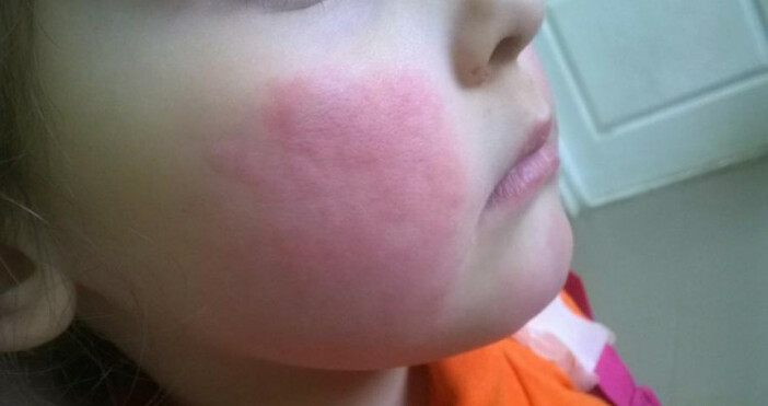 Всеки десети в България пламва от студова алергия когато живакът