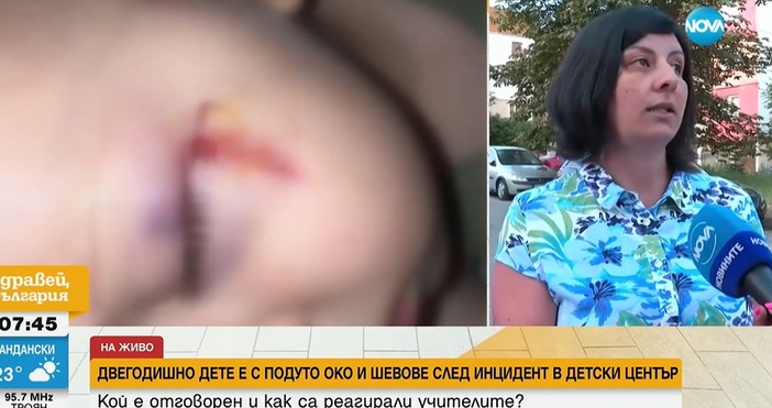 2-годишно дете е с шевове на лицето след инцидент в
