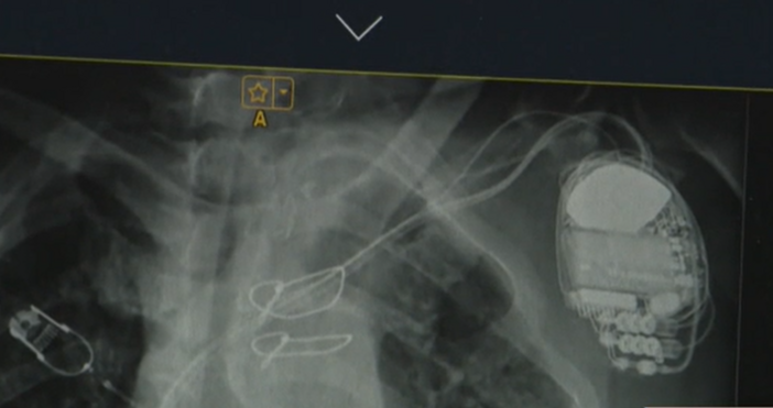 За втори път у нас поставиха две изкуствени сърца на