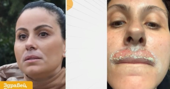 Жена твърди че е обезобразена след дерматологична процедура с лазер
