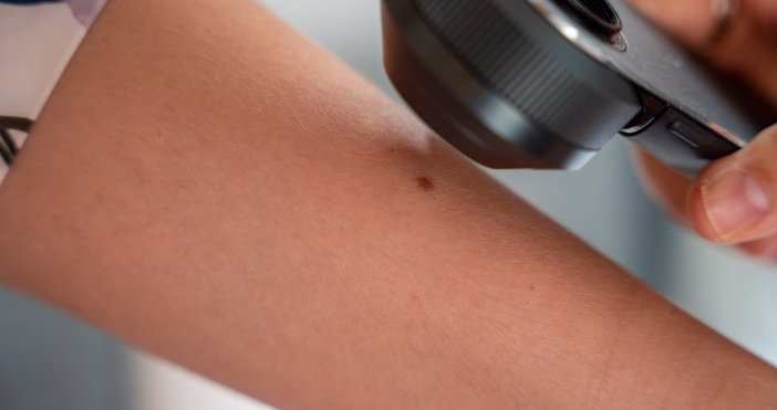 Безплатни профилактични прегледи на бенки ще бъдат организирани за варненци