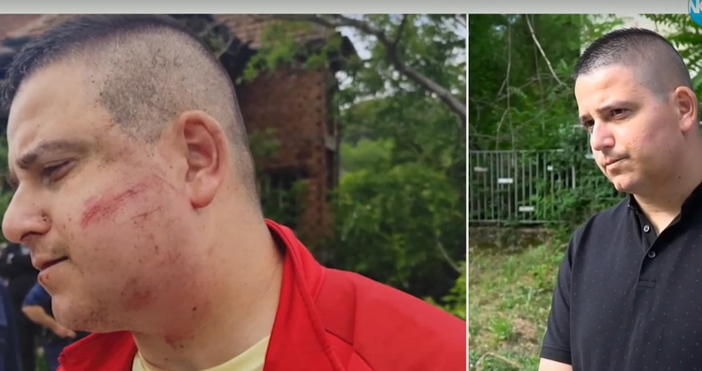 Мъж от Силистра твърди че е станал жертва на полицейско насилие довело