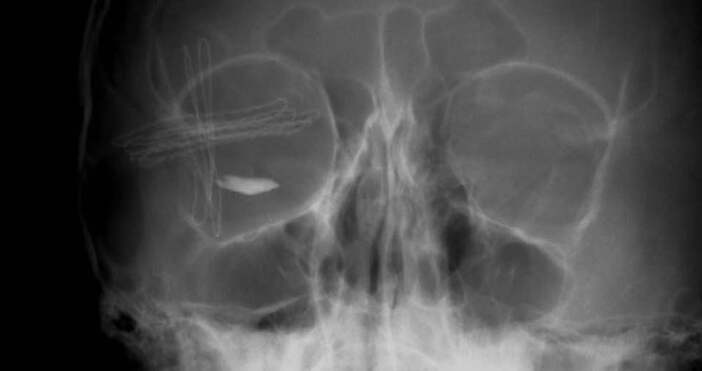 Снимки Фейсбук Alec OscarЛекари спасиха зрението на 11 годишно дете получило