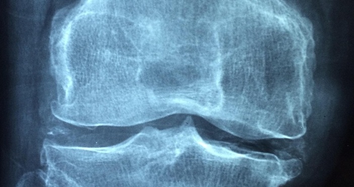 Повече от 420 000 българи страдат от остеопороза като 80 4