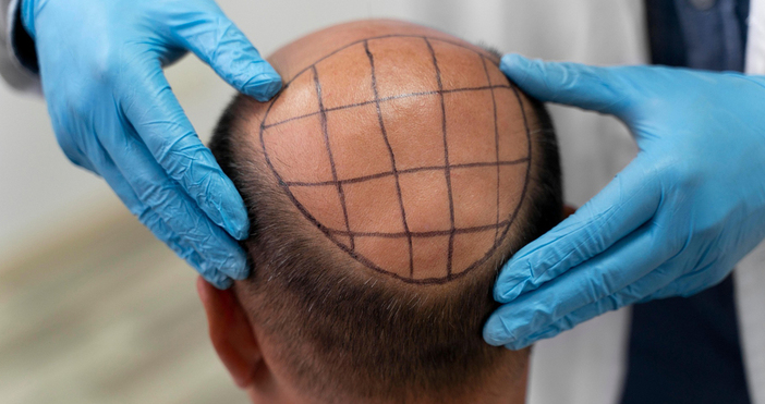 36 годишен британец почина след присаждане на коса и стоматологични процедури