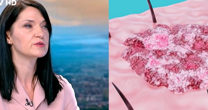 Тревожни данни за рака на кожата Все по млади хора чуват